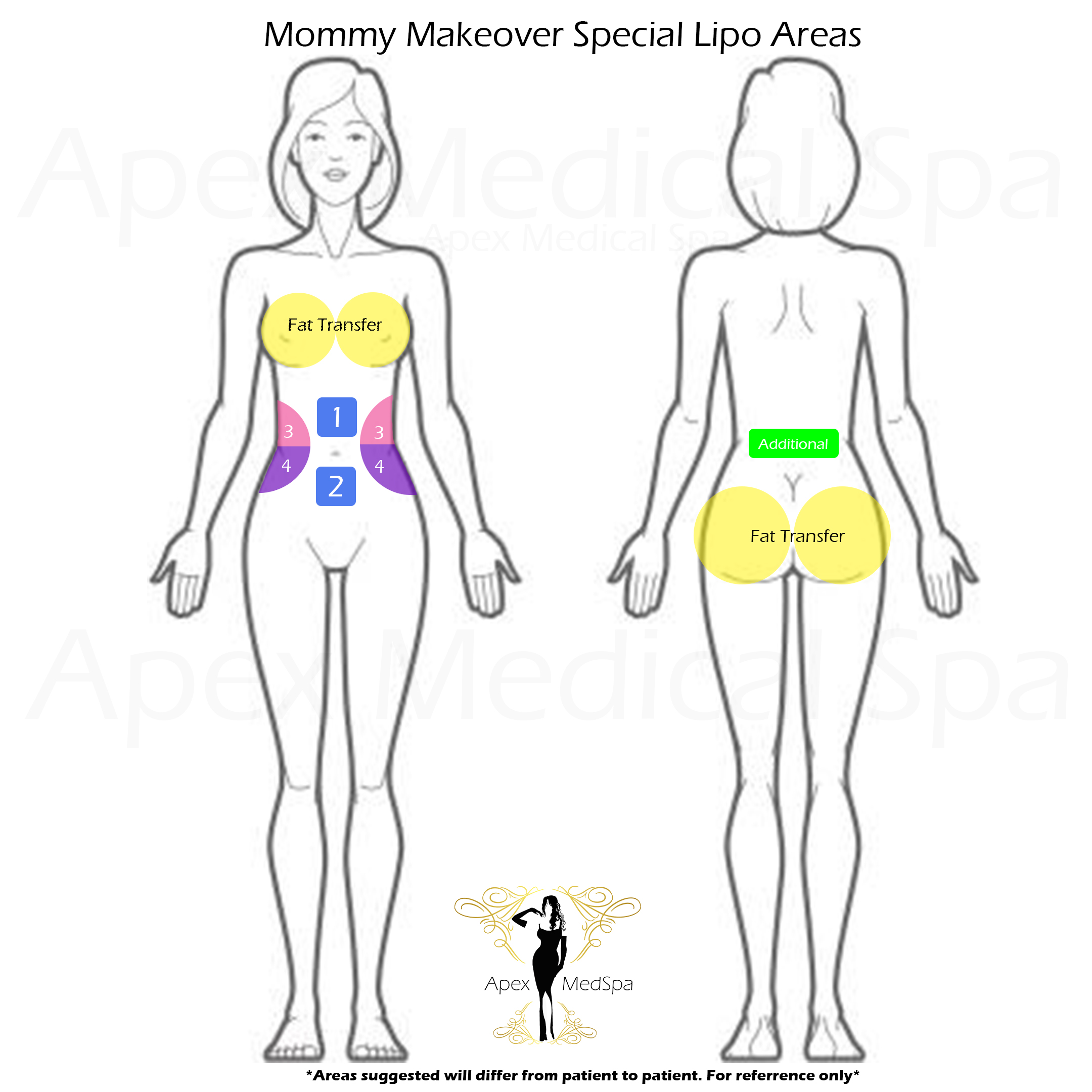 Suggested areas for Mommy Makeover Lipo