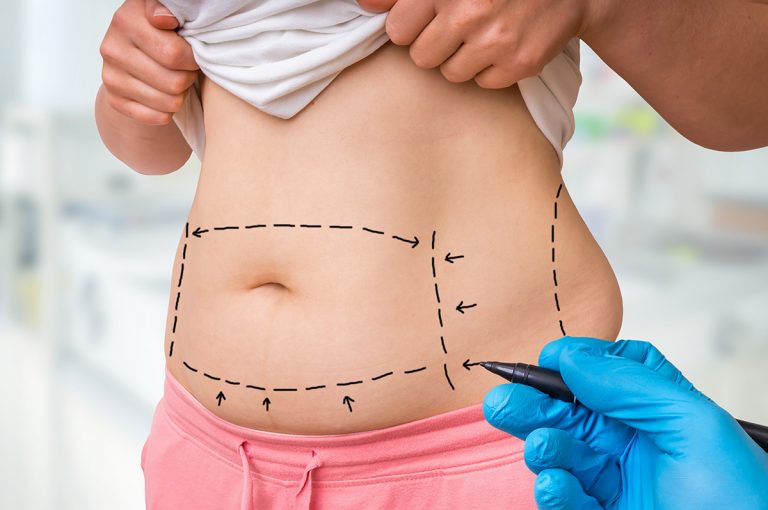 Four Areas of Liposuction w/Lipo Scar Treatment Apex Medical Spa
