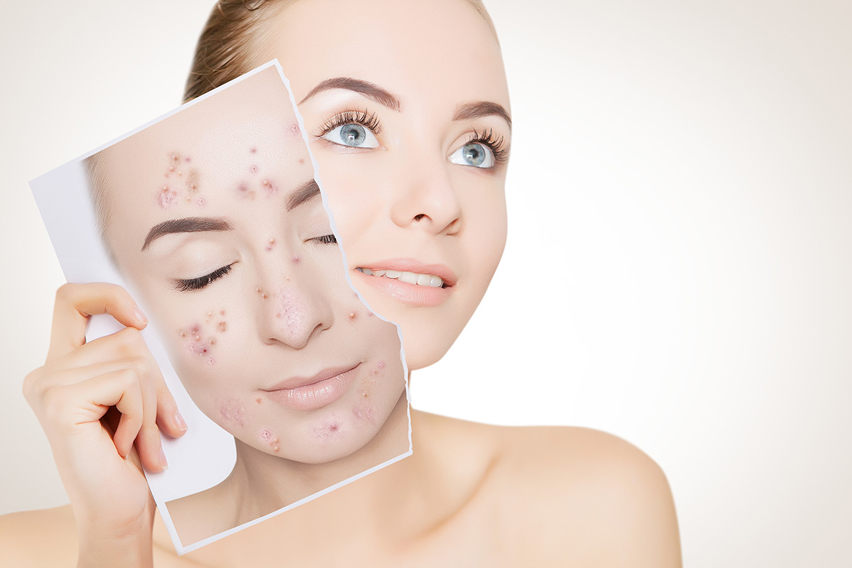 https://apexmedicalspa.com/wp-content/uploads/Laser-Acne-Treatment.jpg