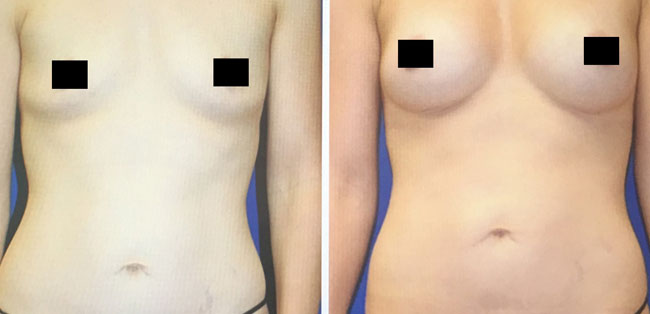 Patient 4 - Fat Transfer - Breasts