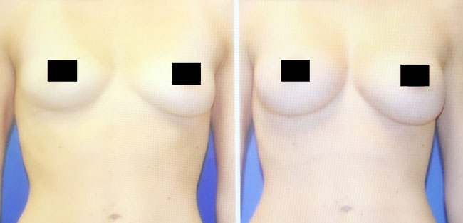 Patient 3 - Fat Transfer - Breasts