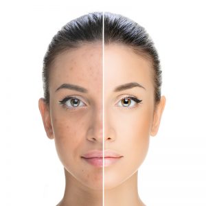 Laser Genesis Photo Facial Treatment