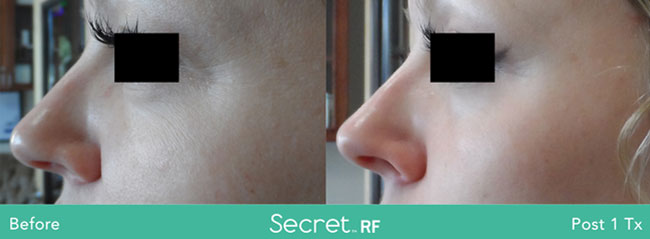 Secret Rf 17