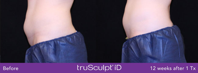 TruSculpt ID 7